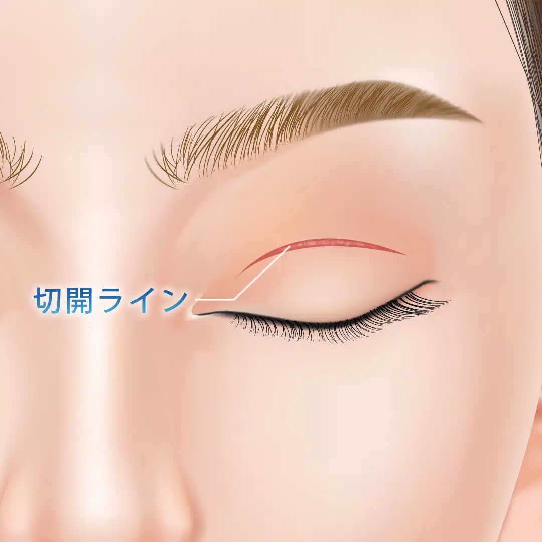 二重全切開　仙台