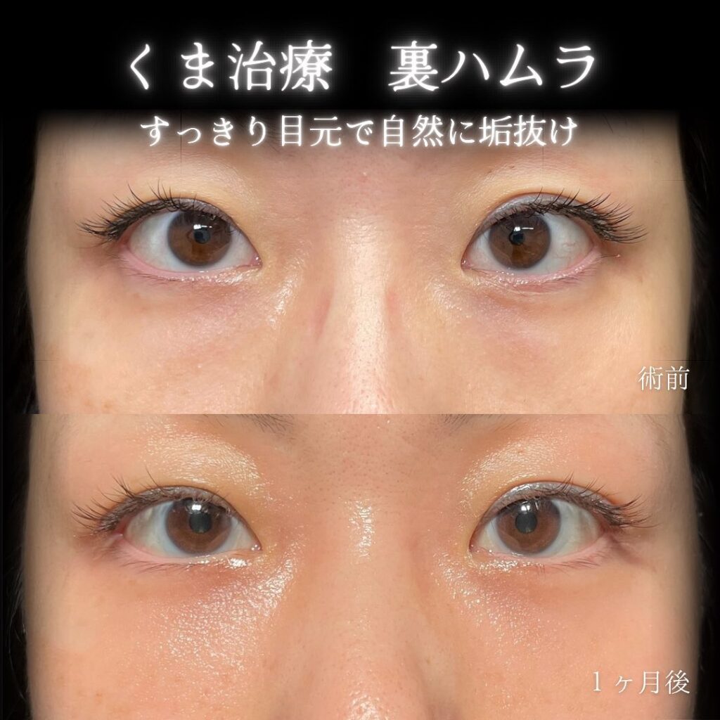 eクリニック仙台院の裏ハムラの症例画像(5)