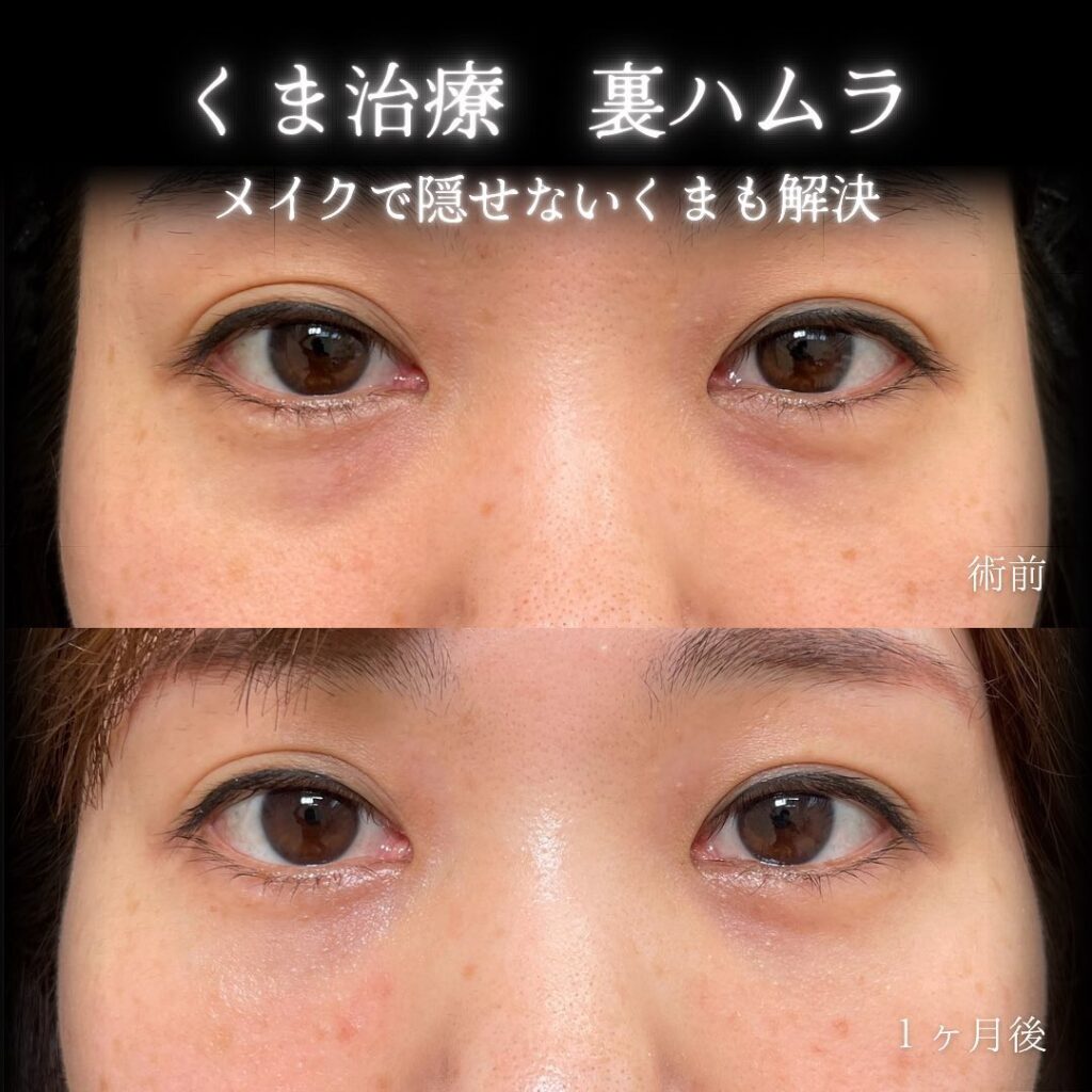 eクリニック仙台院の裏ハムラの症例画像(4)
