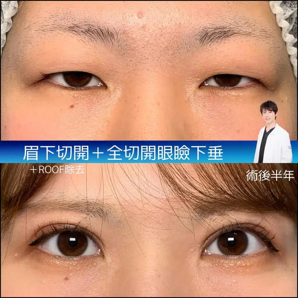 眉下切開 全切開眼瞼下垂 ROOF除去 仙台