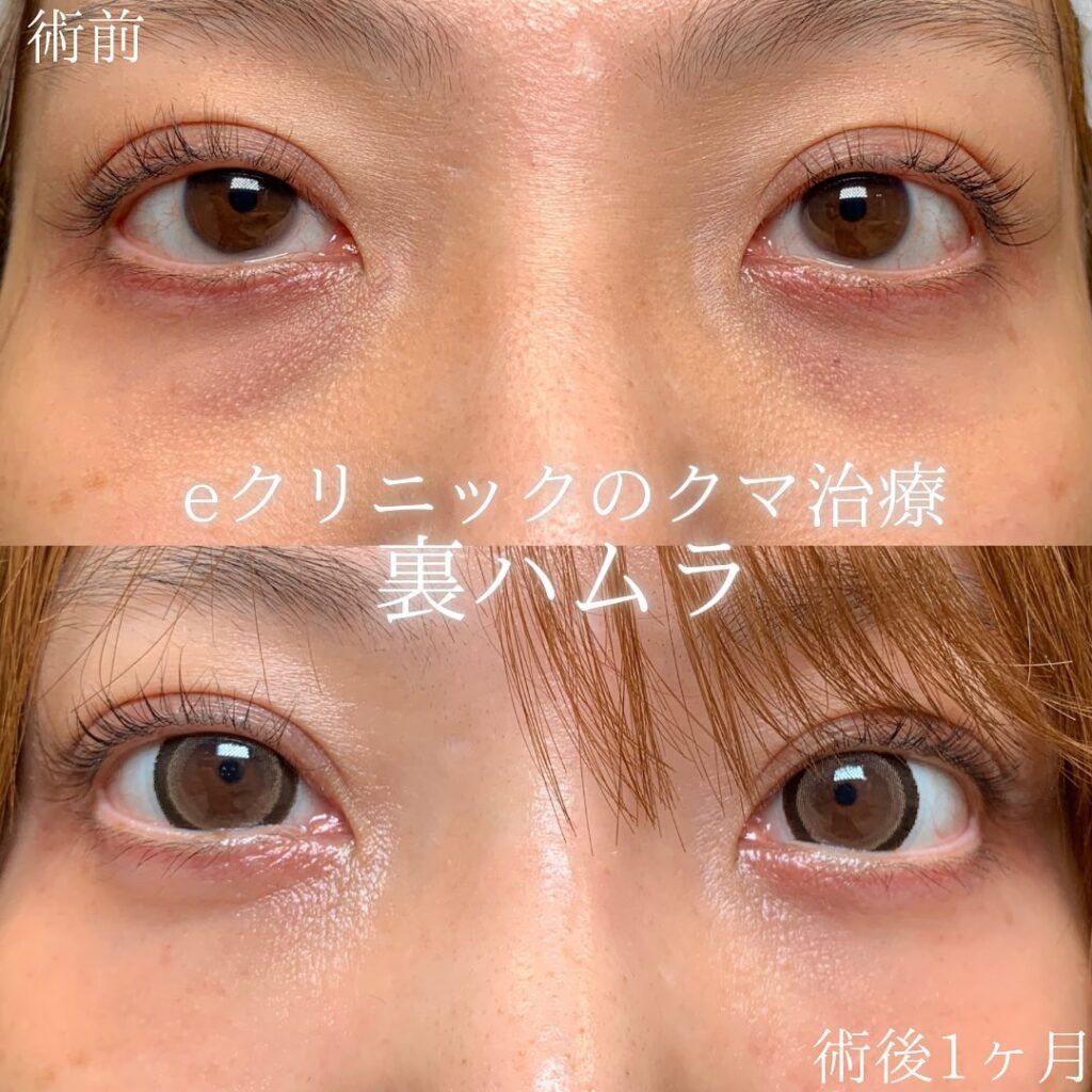 eクリニック仙台院の裏ハムラの症例画像(1)