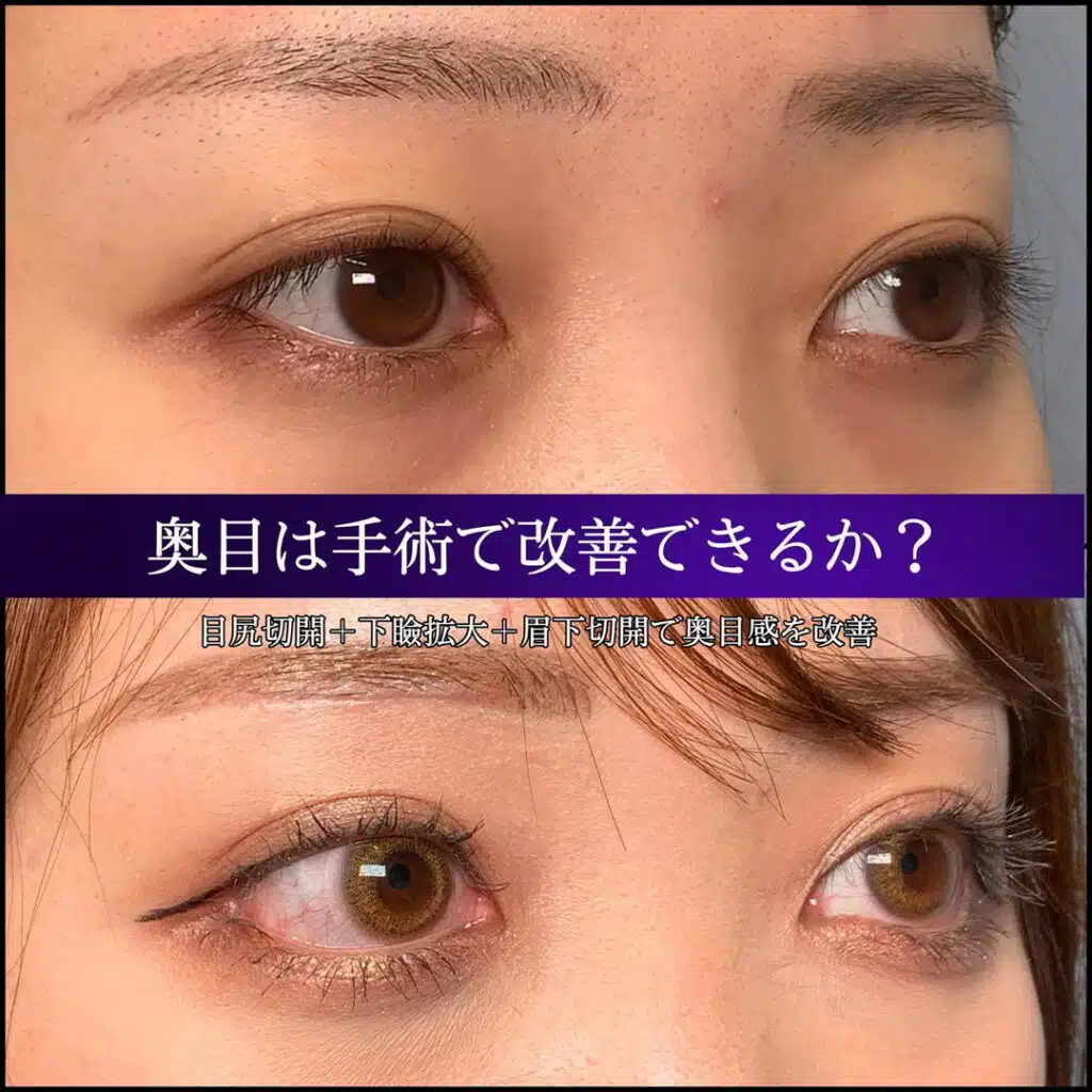 目尻切開 下瞼拡大 眉下切開 仙台