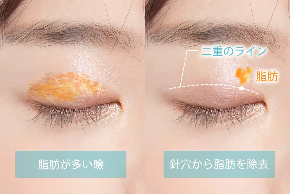 まぶたの脂肪取り 仙台