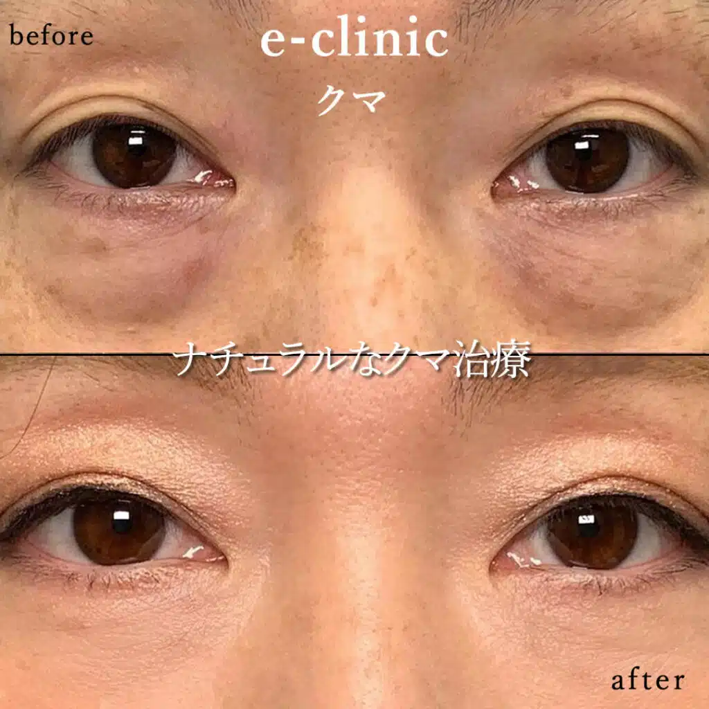 eクリニック仙台院の経血膜脱脂の症例写真(3)