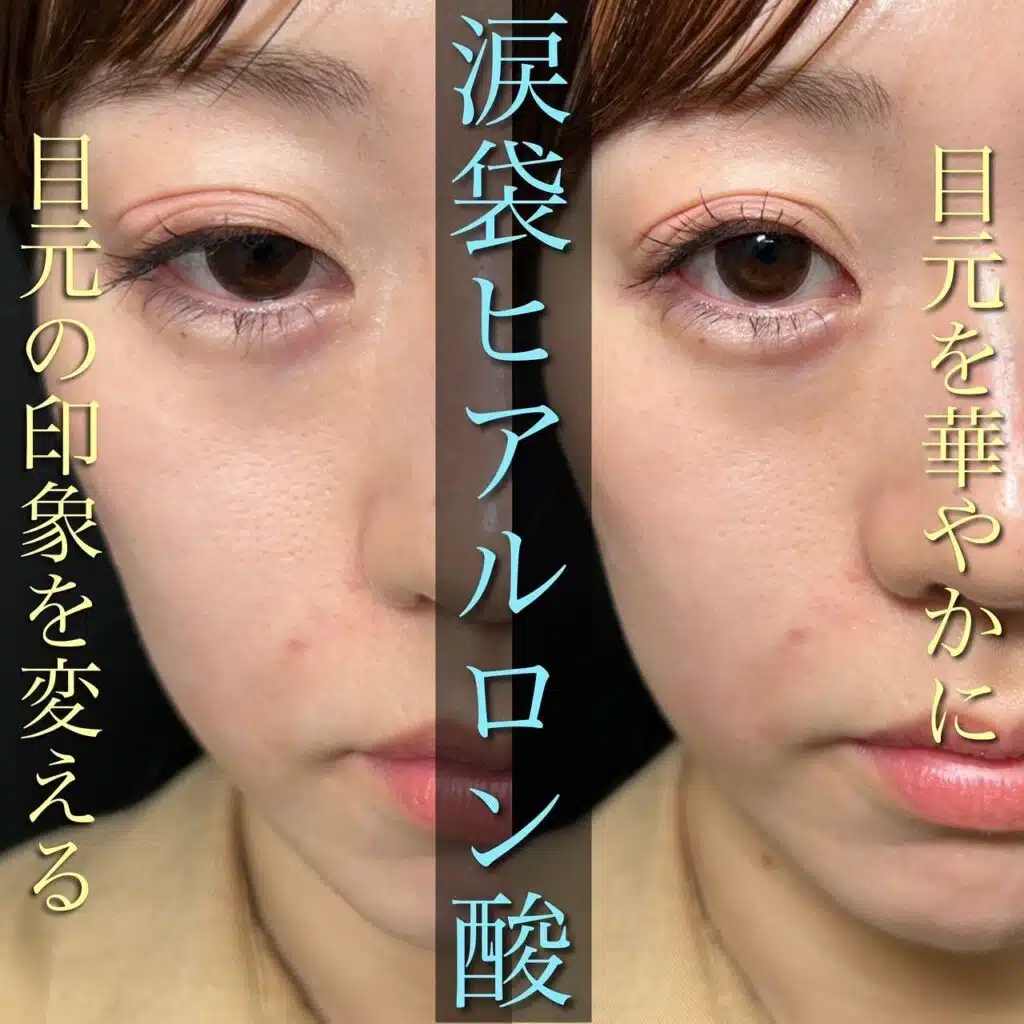 涙袋ヒアルロン酸 仙台
