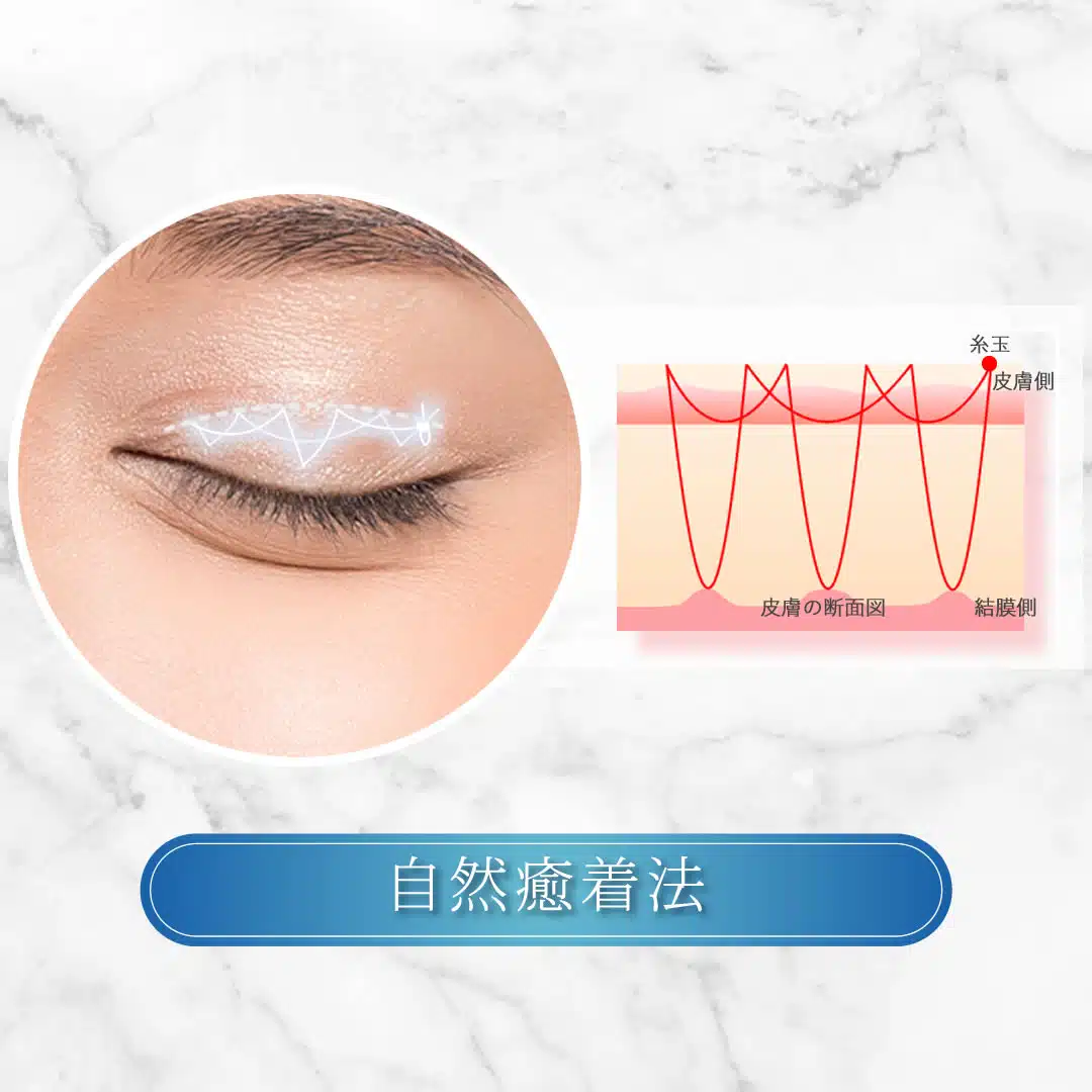 自然癒着法　仙台