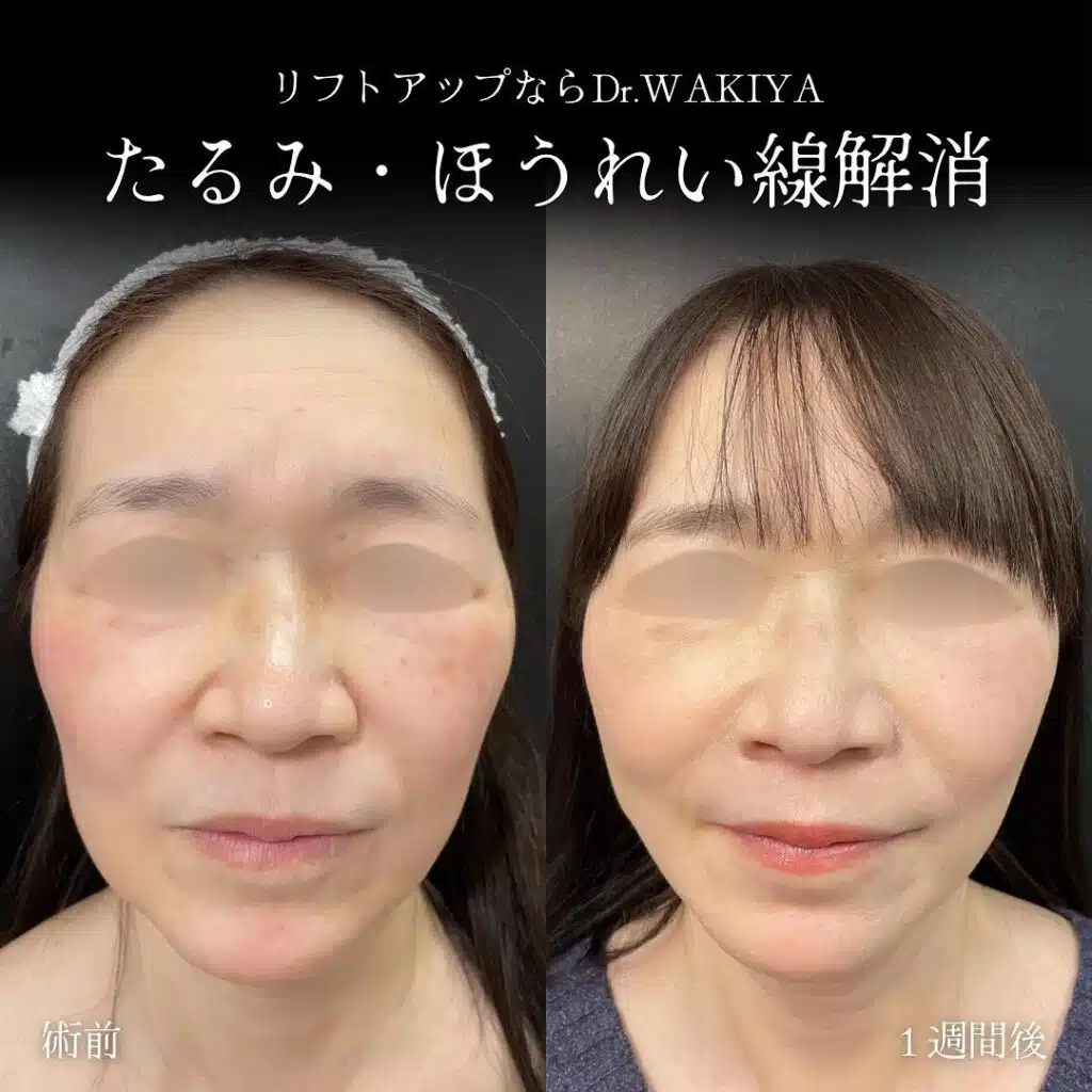 たるみ・ほうれい線解消 仙台