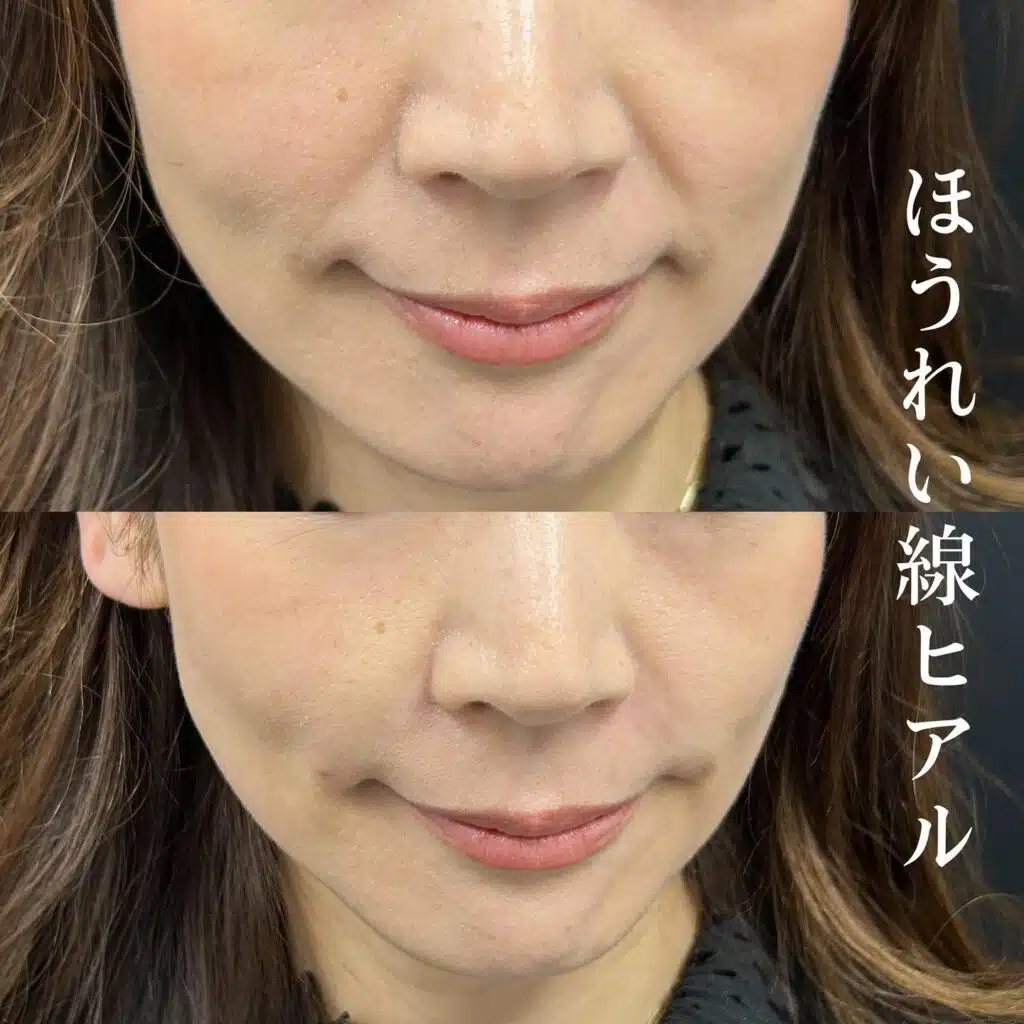 ほうれい線ヒアル 仙台