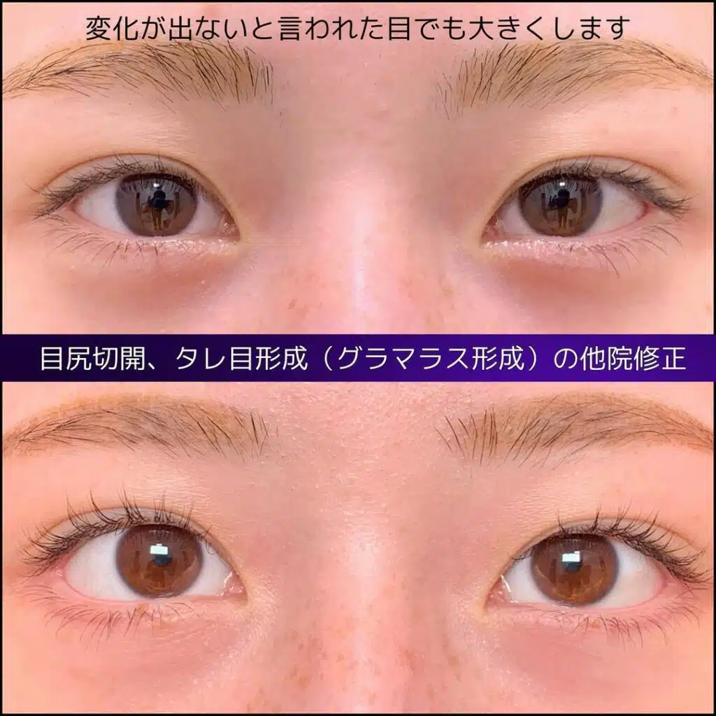 目尻切開 タレ目形成(グラマラス形成) 他院修正 仙台