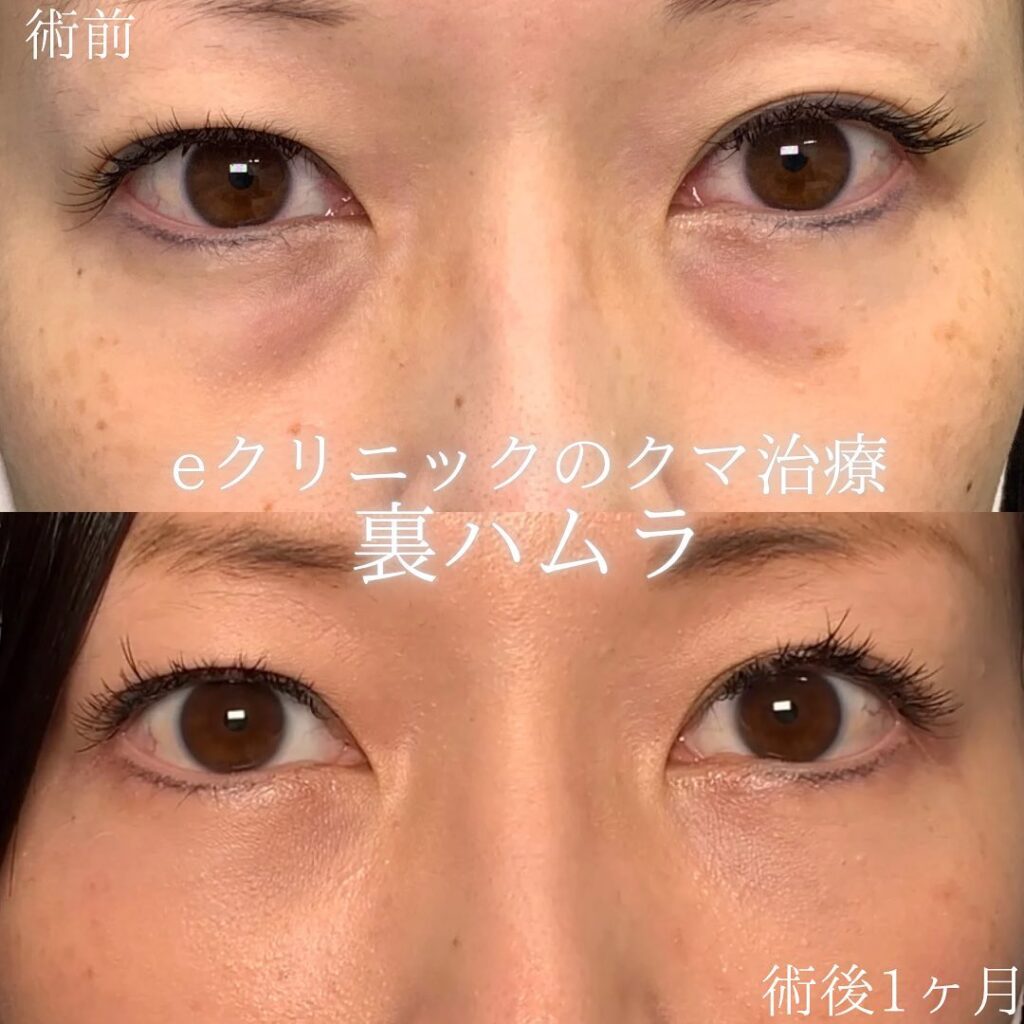eクリニック仙台院の裏ハムラの症例画像(3)