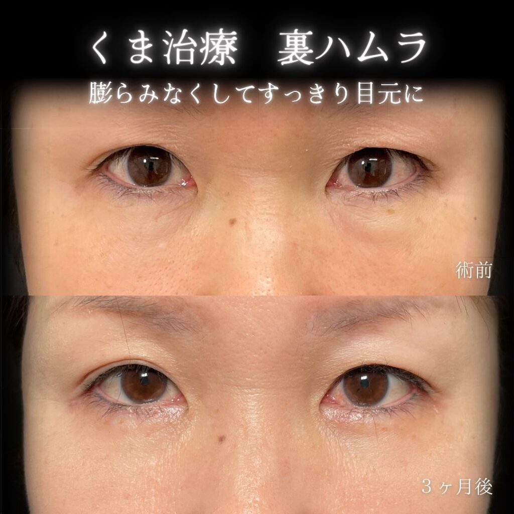 eクリニック仙台院の裏ハムラの症例画像(6)