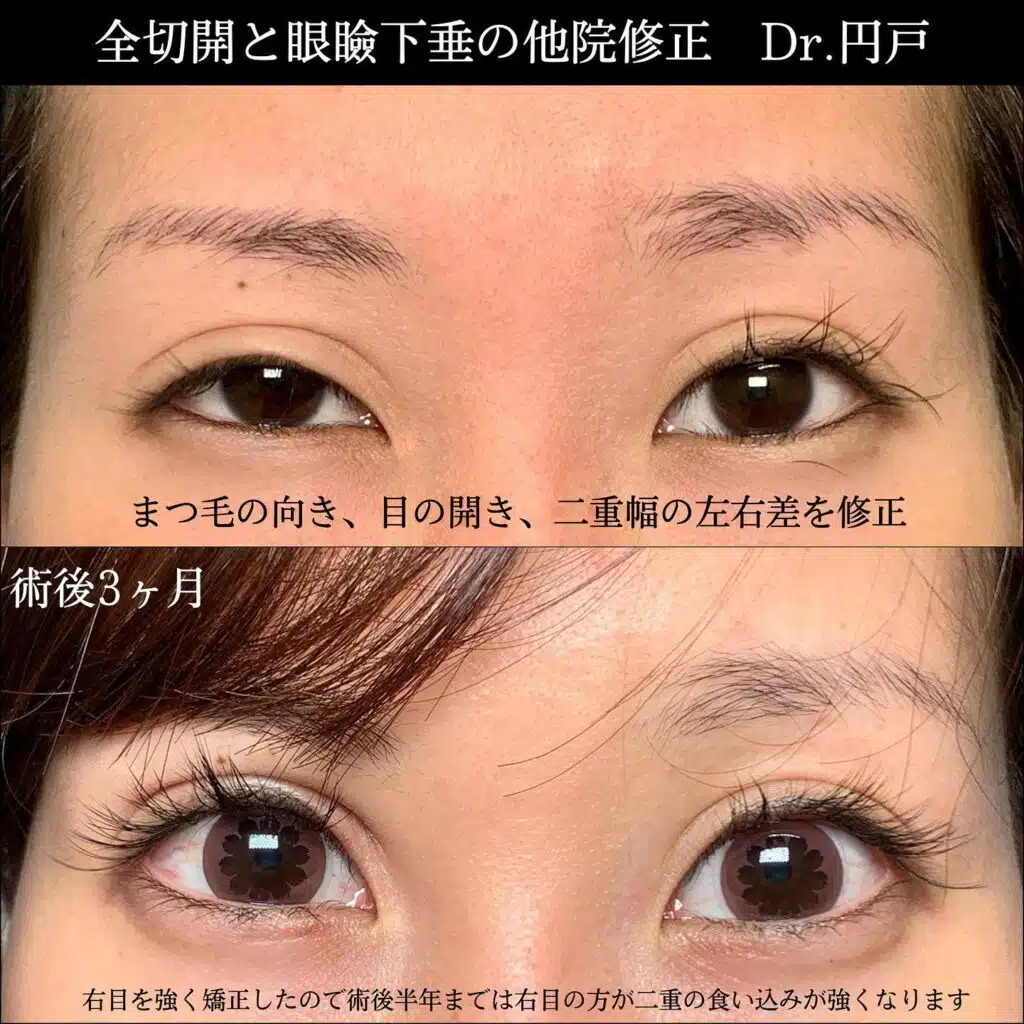 全切開 眼瞼下垂 他院修正 仙台