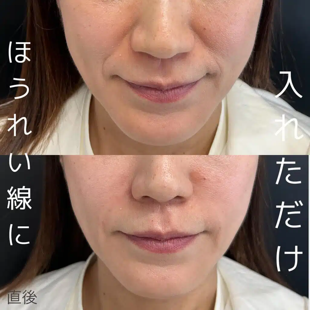 ほうれい線に入れただけ 仙台