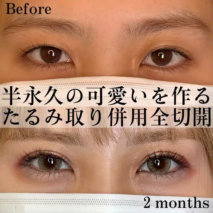 たるみ取り併用全切開 仙台