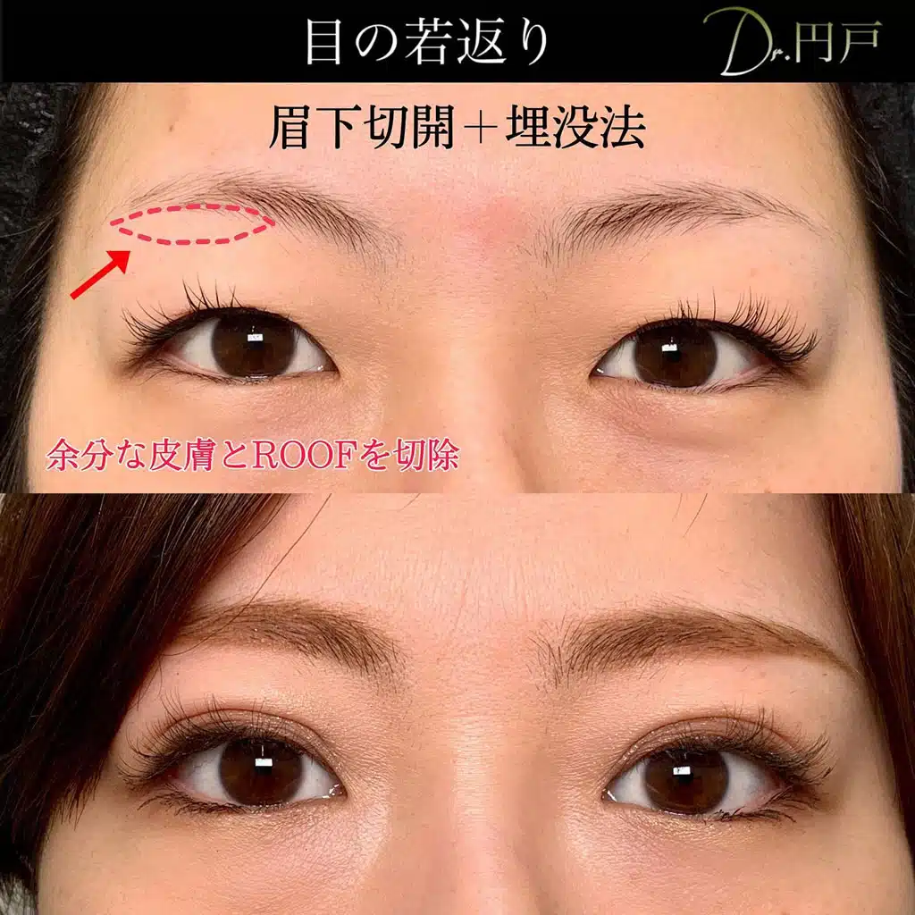 眉下切開 埋没法 仙台