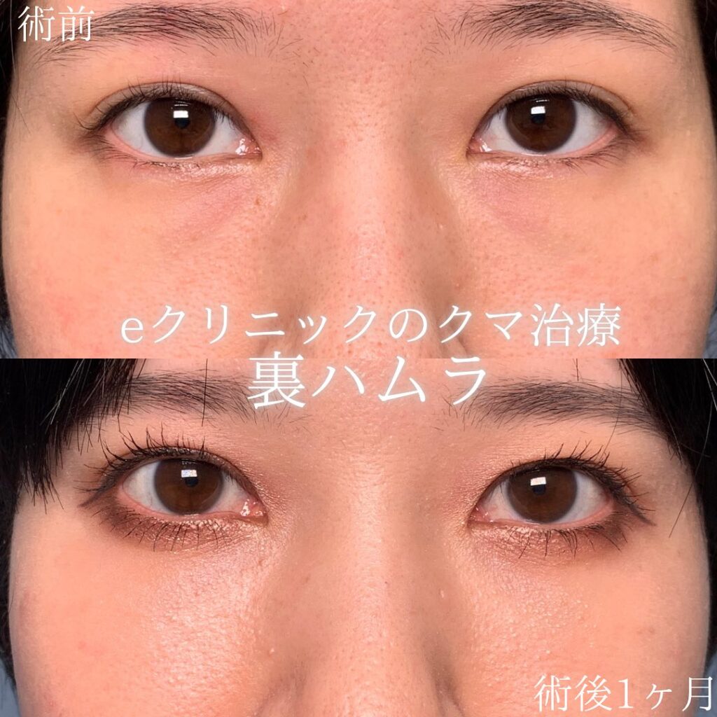 eクリニック仙台院の裏ハムラの症例画像(2)