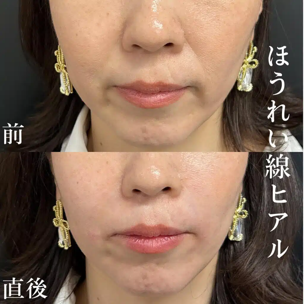 ほうれい線ヒアル 仙台