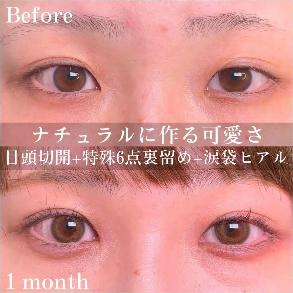 目頭切開 特殊6点裏留め 涙袋ヒアル 仙台