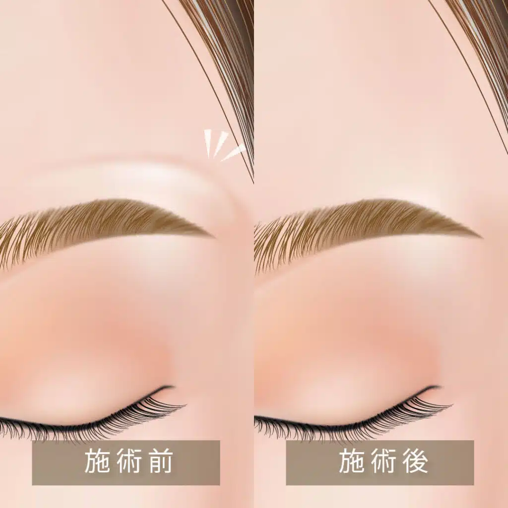 眉上ボトックス 仙台