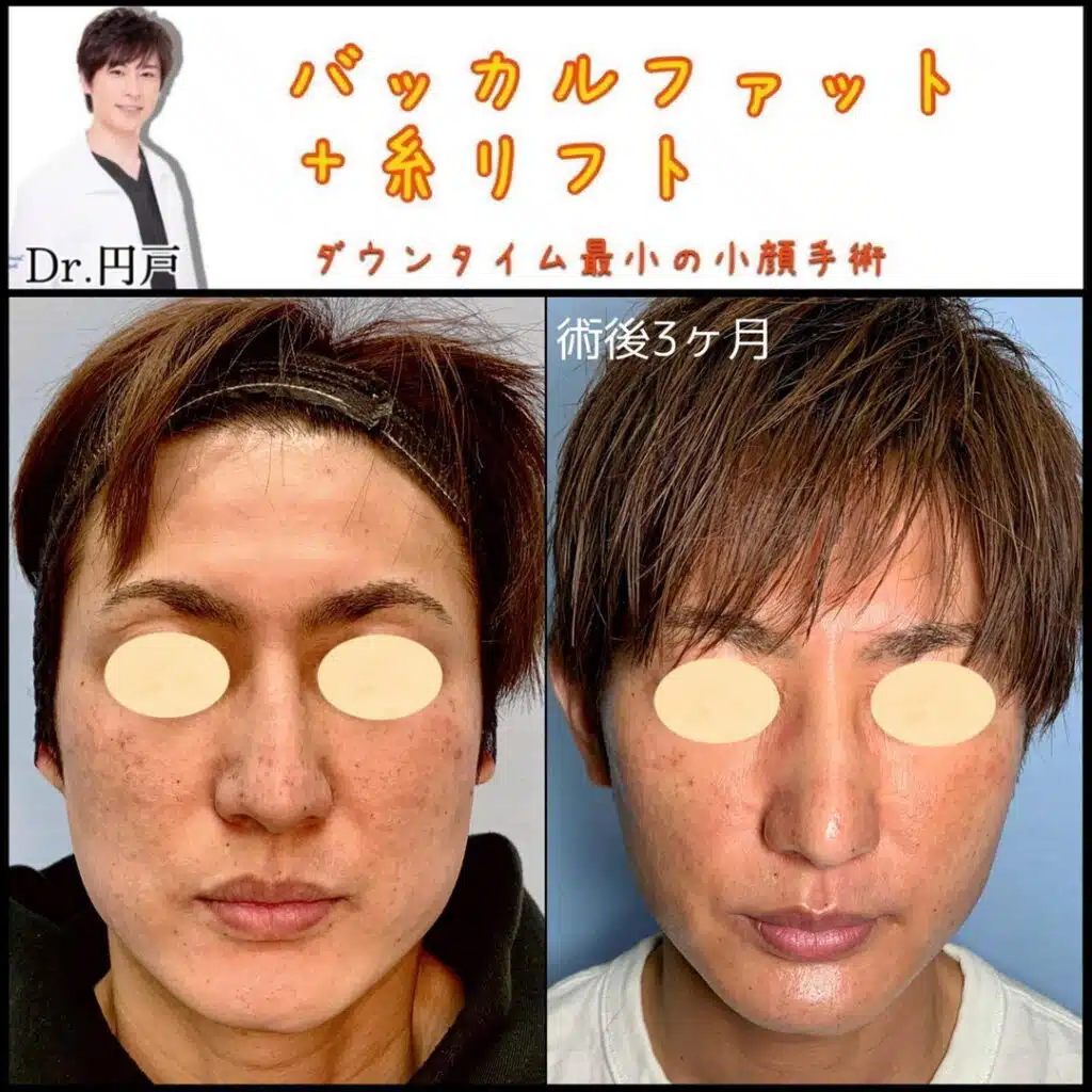 バッカルファット+糸リフト 仙台