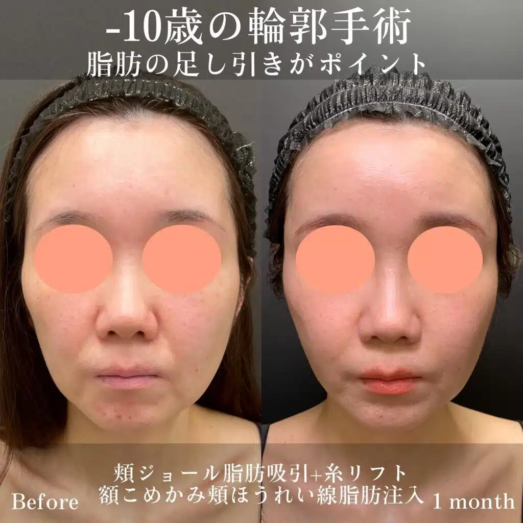 頬ジョール脂肪吸引+糸リフト 額こめかみ頬ほうれい線脂肪注入 仙台