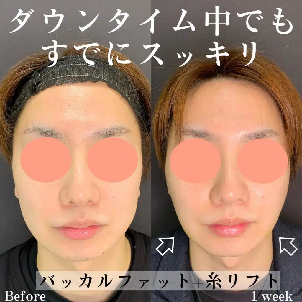 バッカルファット+糸リフト 仙台