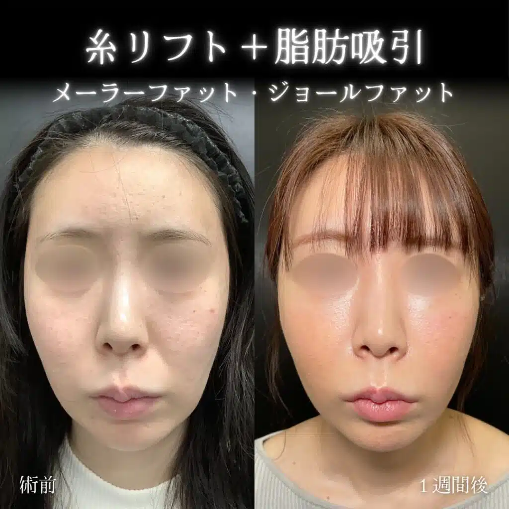 糸リフト+脂肪吸引 仙台