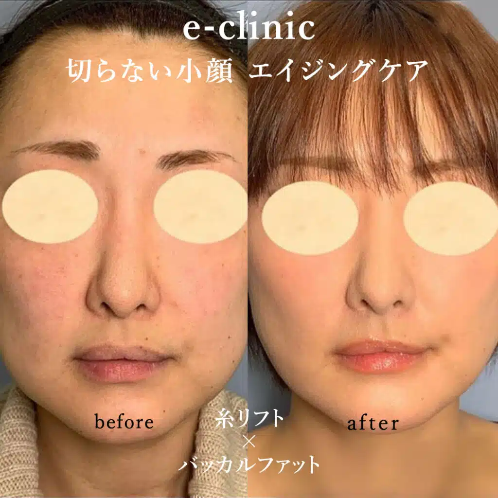 切らない小顔 エイジングケア 糸リフト×バッカルファット 仙台