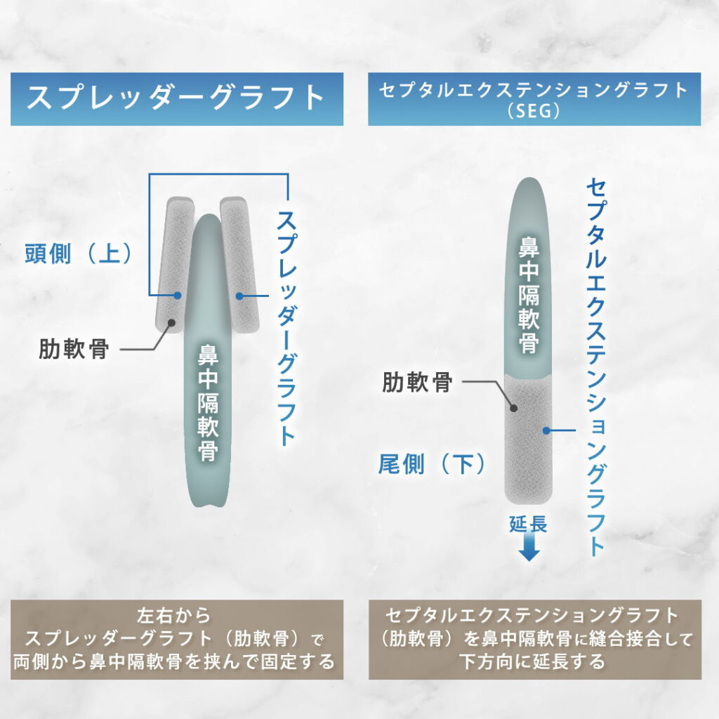 スプレッダーグラフトとセプタルエクステンショングラフトの違い