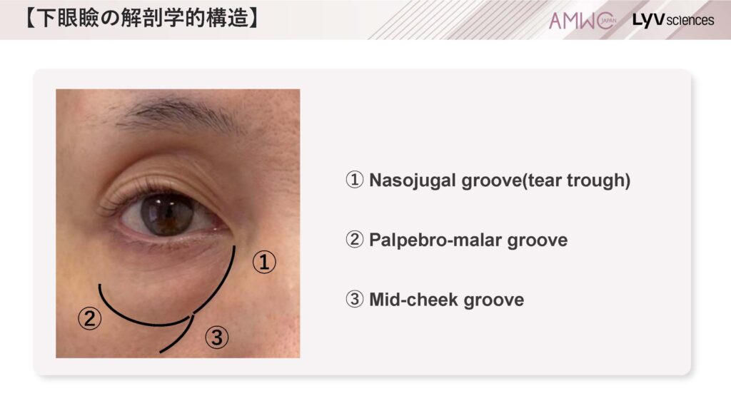 9_経結膜的眼窩脂肪移動術（裏ハムラ法）とは
